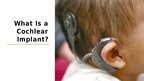 Prezentációk 'Cochlear Implant', 3.                