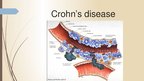 Prezentációk 'Crohn's Disease', 4.                