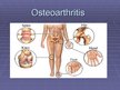 Prezentációk 'Osteoarthritis', 1.                
